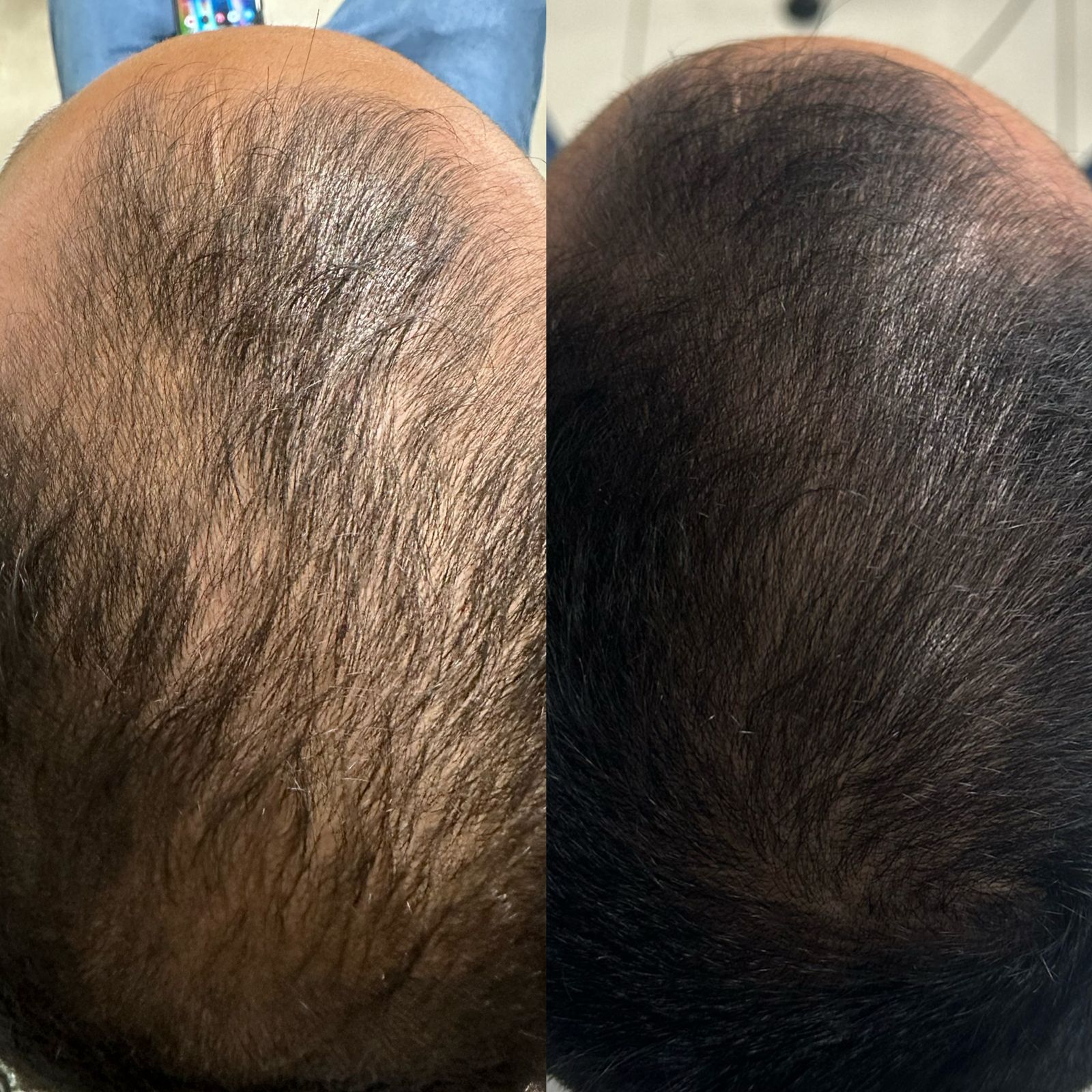 Antes e depois de reconstrução capilar com tratamento para estimular crescimento dos fios