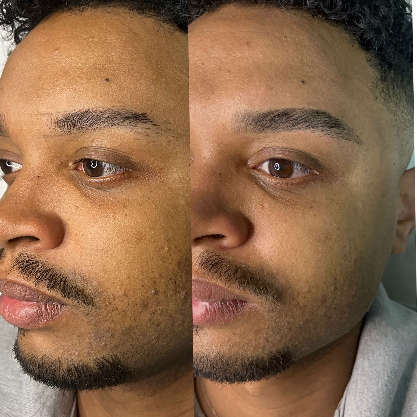 Antes e depois de micropigmentação de sobrancelhas masculina