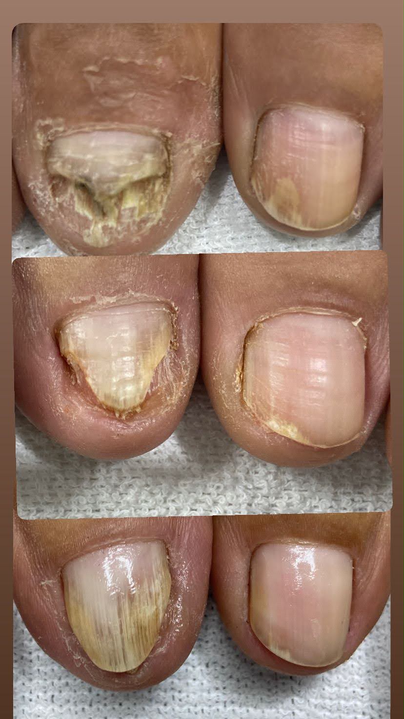 Progressão do tratamento de micose de unha a laser em três etapas